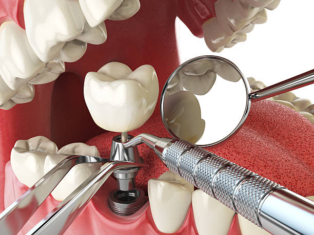 Best Knocked-Out Tooth (Avulsed Tooth) Treatment in Cameron, MO